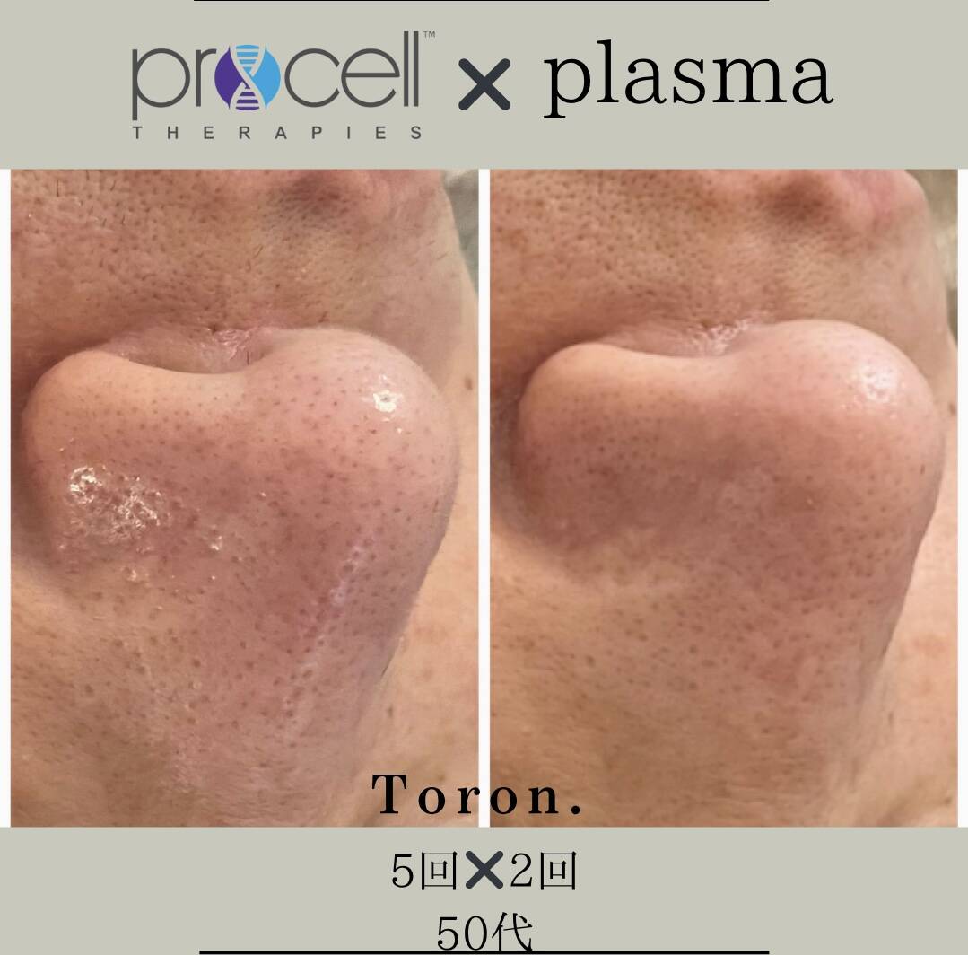 procellフェイシャル | Toron.